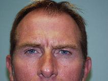 Botulinum toxin Before